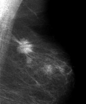 第 6 回千葉乳房画像研究会教育講演資料 (2004/7/17) 2 カテゴリー 1: 異常なし (negative) カテゴリー 2: 良性 (benign) 乳房は左右対称で 腫瘤 構築の乱れも石灰化も存在しない 血管や点状の 1,2 個の石灰化 正常大の腋窩リンパ節 高濃度乳房をよく乳腺症としてカテゴリー 2 にする誤解があるがほかに異常所見がなければカテゴリー 2 とする