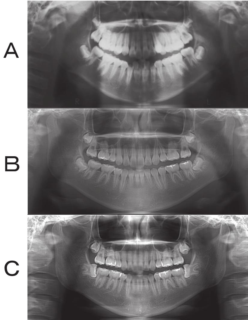 両側上下顎第三大臼歯の存在が認められた 歯及び 歯槽骨に特記すべき異常は認めなかった 指末節骨の骨端の癒合は認められなかった 6 2 診断