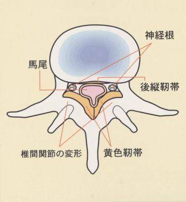 腰部脊柱管狭窄症について 整形外科医長平澤洋一郎