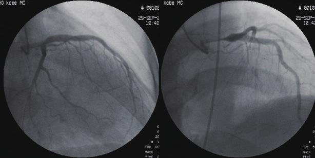 大動脈解離による LMT 閉塞に対するステント留置 図 1 初回心電図. II III av F ST 図 2 左冠動脈造影. 30 30 透亮物で内腔が閉塞されており, さらに右側シース造影でも同様の所見が認められた ( 図 3).