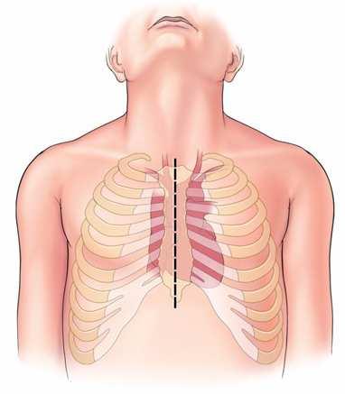 弓部大動脈を全部取り換える場合は 頭へ行く 3 本の血管も人工血管でつなぎます また