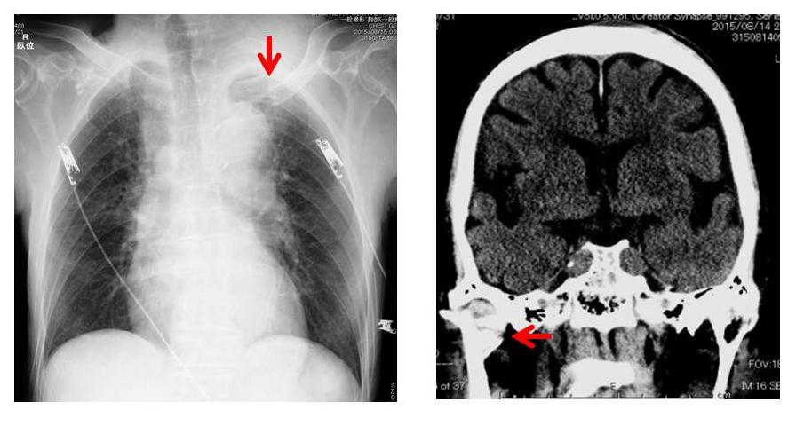 図 1 左 : 胸部レントゲン ; 縦隔及び心陰影の拡大と左鎖骨骨折