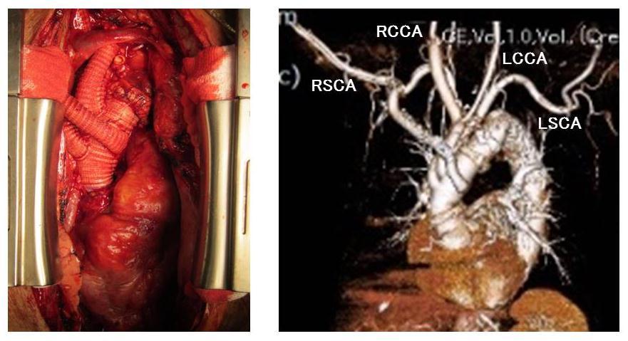 図 4 左 : 術中写真 ; 人工血管による再建後右 : 術後 3D-CT RSCA;