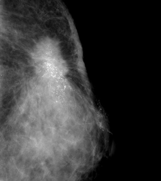 小さい腫瘍 石灰化した微細な乳癌 ) も高感度に検出可能である MLO と CC