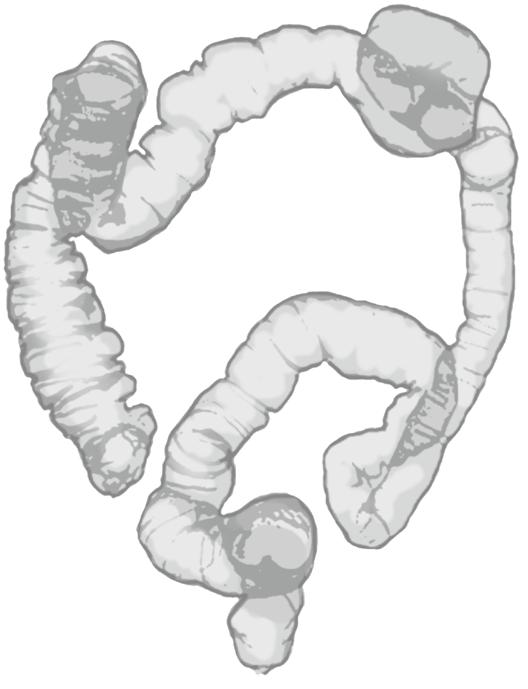 大腸内視鏡検査の様子変部の表面構造を画像強調観察や拡大観察を用いて より精密な検査を行う場合もあります 5)CTコロノグラフィ ( 大腸 3D-CT)