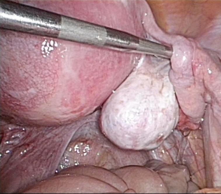 左卵管妊娠 (