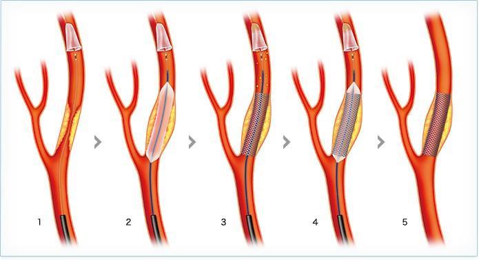 頚動脈ステント局所麻酔下に 足の付け根の血管 ( 大腿動脈 ) からカテーテルを通して 血管の中から狭窄部位を広げる治療です 頚動脈の狭窄部分に " ステント " と呼ばれる金属性の網状の筒を留置して 血管を拡張させ