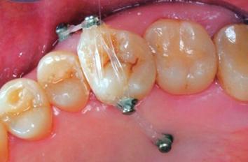 患者さんの 協力がなくても歯の移動に対する反作用を最小限に押さえられるようになった 特に 補綴治療のための M T M に際しては 歯科矯正用アンカースクリューを用いることで 反作用の憂慮なく