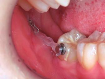 歳 女性主な治療目的 ; 隣接面修復治療のための大臼歯の整直治療経過 ; 下顎第 3 大臼歯の抜歯の際