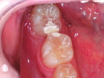 隣接面の修復治療を行った 図 2-1 Closed method による大臼歯の整直 術前術中