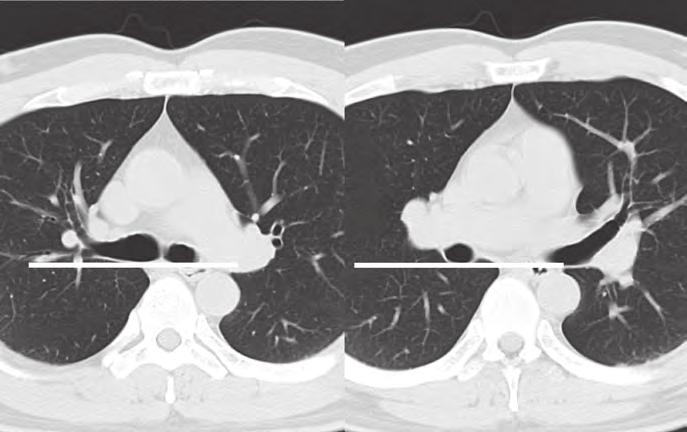 図 28 CT における中間気管支幹後線条