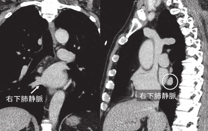 図 30 CT における右下肺静脈 ( 冠状断像, 矢状断像 ) 表 4 左右横隔膜の識別法 左側面像では交叉する 右側面像では常に右が上位 直下に胃泡や結腸脾彎曲部のガス像 左 心臓とシルエットされる ( 前縁不明瞭 ) 左 横隔膜後部が下方に位置する ( 左側面 ) 左 下大静脈によりシルエットされる 右 8) 左上葉気管支輪切り像 (orifice of left upper lobe