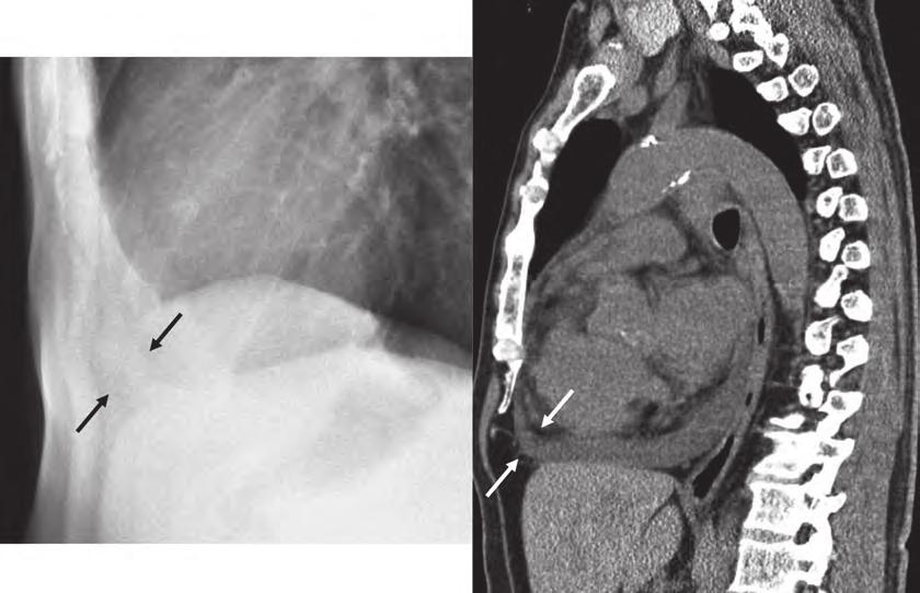 図 32 側面像における心嚢水貯留所見 (displaced epicardial fat pad sign) A 臓側心膜の脂肪と心嚢外脂肪との間に帯状の透過性低下領域が認められる ( 黒 ). B CTの矢状断像ではよりコントラストが明瞭である ( 白 ).