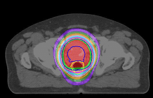 前立腺がんの例 前後左右 4 門照射 直腸を避けるような凹な照射野 3 次元原体照射強度変調放射線治療