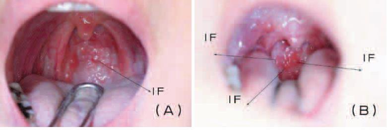 咽頭後壁のリンパ濾胞は感度 95%, 特異度