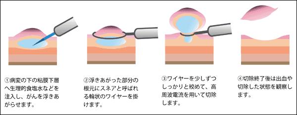 内視鏡的切除の方法 内視鏡的切除の方法には 内視鏡的粘膜切除術(EMR)