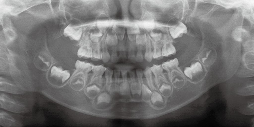 2 の先天欠如 が認められ 上顎右側 側切歯 2 は矮小歯 となってい 第二小臼歯は稀に 5