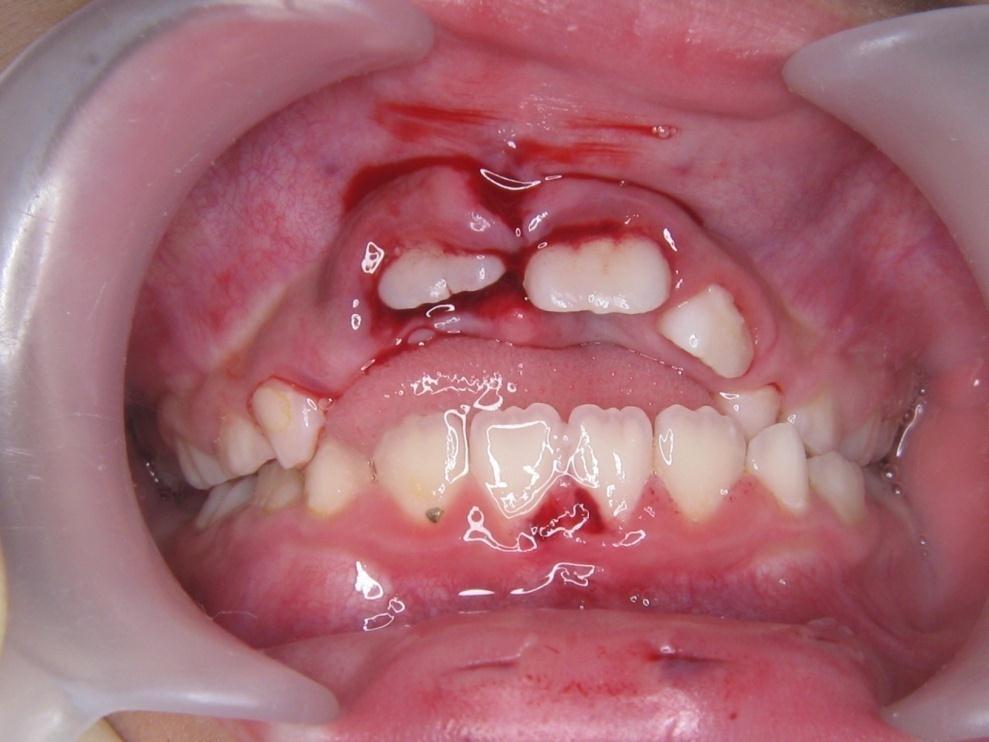 歯の埋入 初診時