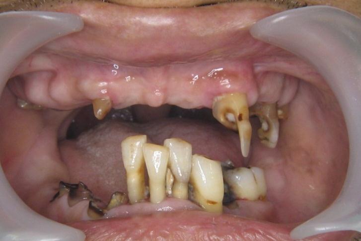 多数の齲触歯
