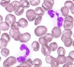 好中球の増減 白血球増加 10,000/μL 以上 白血球減少 3,000 /μl 以下 増加の原因 7,500/μL 以上減少の原因 2,000/μL 以下 好中球 血液疾患 慢性骨髄性白血病真性多血症慢性好中球性白血病