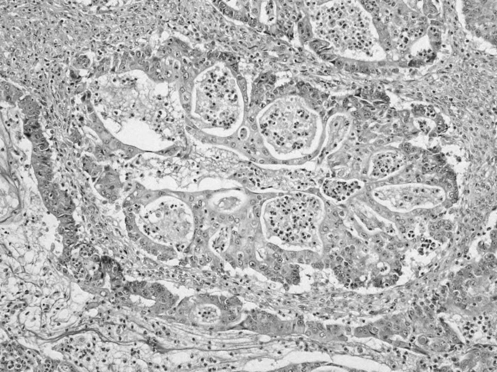 37 seromucinous Lee Kurman RJ et al. The origin and pathogenesis of epithelial ovarian cancer : a proposed unifying theory. Am J Surg Pathol Fukunaga M et al.
