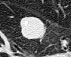 pneumocytoma と考えられている 境界明瞭辺縁平滑な孤立性肺結
