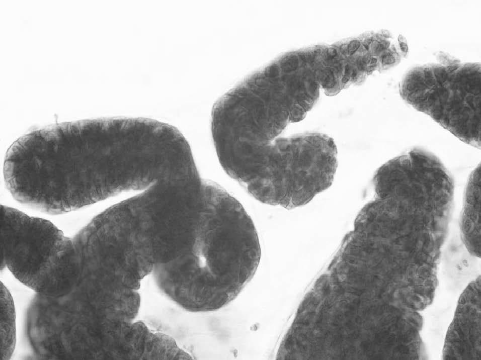 Pap染色 4 図5 AISの子宮頸部擦過細胞像 Pap染色