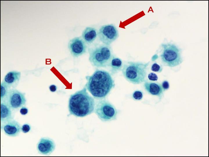 (A) 組織球, (B) 反応性中皮細胞 1/45 施設