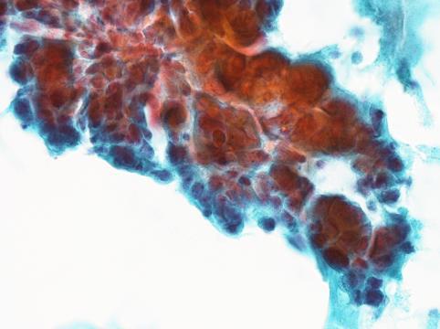 癌肉腫 Pap /3 問 3 細胞質変化 ( 好酸性変化 ) 
