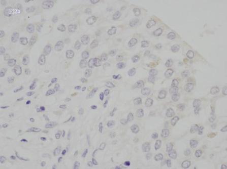 手術標本における浸潤癌症例では 腫瘍周囲や尿管部の正常に見えるような場所においても EGFR と p53 の過剰発現が認められ 癌が発生する患者の尿路組織では 発ガンに関わる因子に暴露されることによって組織の広範囲に EGFR と p53 が恒常的に過剰発現していることがわかった 100 90 80 70 60 50 40 30 20 10 0