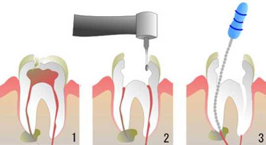 Step 1 Step 2 感染予防に繋げる口腔管理 口腔管理開始前の口腔内のアセスメント 1) 看護師によるアセスメント