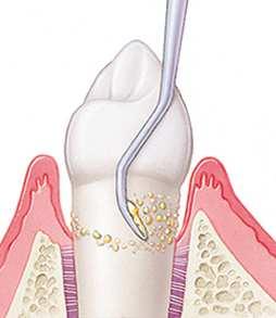 ための環境整備 1) 構造的回復 ( う蝕 歯周病 粘膜炎の治療 感染源除去 ) 2) 機能的回復 ( 咬み合わせ