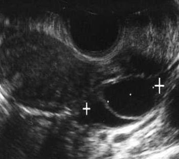 3 ( 図 3) 排卵直前の卵胞 ( 図 4) 排卵期の子宮内膜 ( 図 5) 子宮卵管造影 ( 直径 >20mm) ( 厚さ >10mm) ( 両側卵管通過性のある方 ) これらのスクリーニング検査において何か異常所見があった場合には 必要に応じてさらに進んだ精密検査 ( 腹腔鏡 子宮鏡 ホルモン負荷試験 CT MRI 染色体検査など) を行ないます また