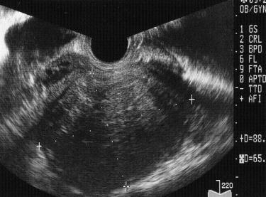 * 子宮周囲の組織 ( 靱帯 卵管など )