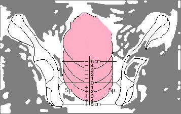 0 1 2 3 児頭の位置 (station) -3-2 -1,0 +1~ 子宮口の位置 後方 中央 前方 頚部の硬度 硬 ( 鼻翼状 ) 中 ( 口唇状 ) 軟 ( マシュマロ状 ) 頚管開大度 (cm) 0 1~2 3~4 5~6 頚管展退度 (%) 0~30 40~50 60~70 80~ e.