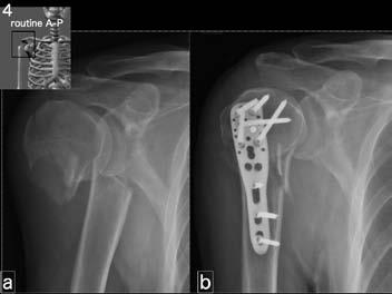 図 4 上腕近位骨折 -3fracture of the proximal humerus a 近位骨片は棘上筋により外転, 遠位骨片は大胸筋により内旋 b
