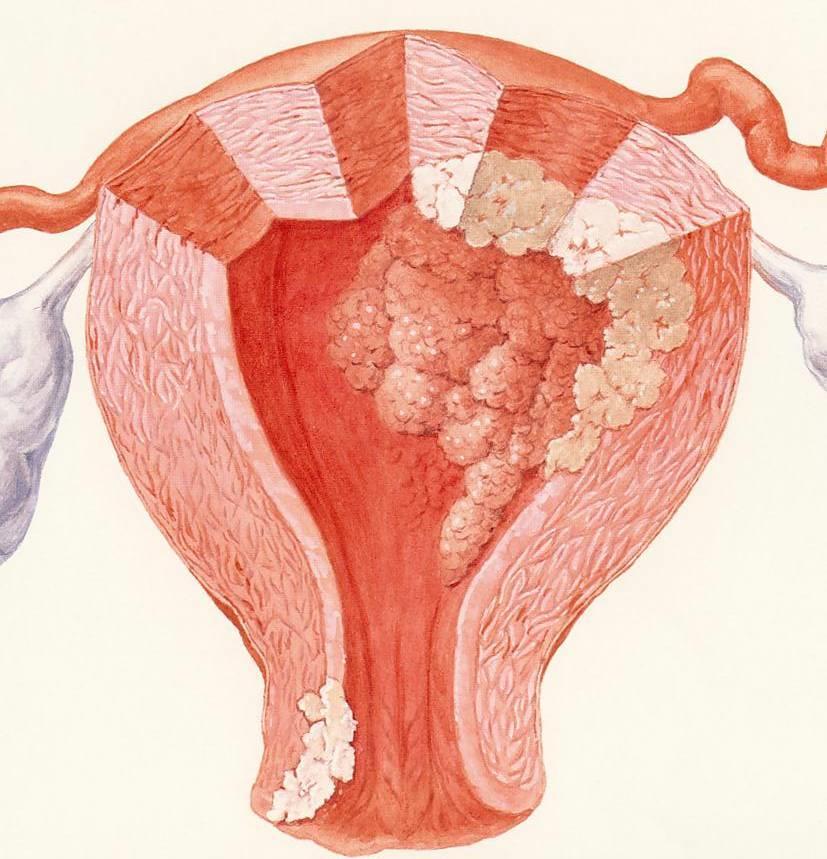 子宮がんには 2 つの種類があります