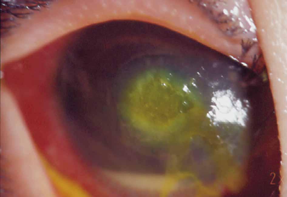 ) モラクセラ ( 図 32) モラクセラは大型のグラム陰性双桿菌であり, 以前から眼角眼瞼結膜炎の起炎菌として知られているが, 全身状態の不良例では中央に角膜炎を生じることがある. 緑膿菌やモラクセラ以外のブドウ糖非発酵グラム陰性桿菌も角膜炎を惹起する. ) セラチアセラチアはグラム陰性の小 ( 短 ) 桿菌で, 緑膿菌と同様に日和見感染菌とされている.