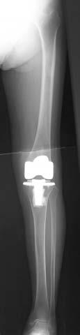 浅野, 成田, 大木, 高窪, 高木 図 3. 単純 X 線下肢全長正面における人工膝関節全置換術のコンポーネント設置角度大腿骨機能軸と大腿骨コンポーネントの冠状面のなす角度 (α 角 ) 脛骨機能軸と脛骨コンポーネントの冠状面のなす角度 (β 角 ) とした 図 4. レジストレーションの誤差大腿骨の関節軟骨表面 骨表面の誤差 (a) 脛骨の関節軟骨表面 骨表面の誤差 (b) 2.