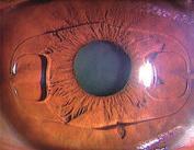 より快適に見る 03 高度近視の治療 フェイキックＩＯＬ 眼の中に半永久的に レンズを埋め込む 画期的な裸眼視力回復の治療法 前房型フェイキックIOL Artiﬂexレンズ 近視や遠視 乱視が強くてレーシックでは矯正できない 眼や