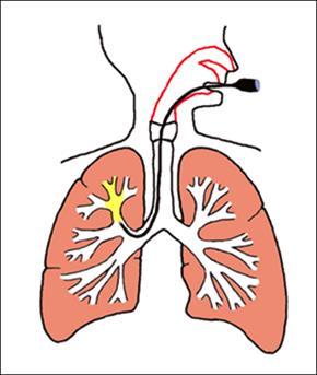 ( 図 2) A2: 肺または気管支など呼吸器の病気を正確に診断するために 口または鼻からのど を 通して気管支鏡 ( 気管支ファイバースコープ )