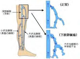 静脈の病気 : 下肢静脈瘤 静脈弁の働きが悪くなることにより 逆流が起こり 静脈が拡張した状態