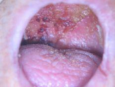 症例 5 口腔乾燥 口腔ケア後の口蓋 41 42