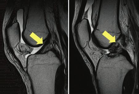図 4 膝前十字靱帯の MRI という膝の動揺性を診る徒手検査でほぼ診断が可能であり 前十字靱帯損傷の確認 また合併する半月やほかの靱帯損傷の評価のために MRI を行い診断が確定する ( 図 4) 前十字靱帯損傷は 保存療法では治癒はほぼ見込めないため手術療法を要する 手術治療としては わが国では自家腱組織 ( 自分の体のほかの部分の腱組織 )