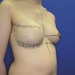 健側の乳房頂部から引いた正面視での水平線 患側 TE の外周縁 TEでのデザイン, マーキングと同様, 乳房の形態および位置は立位または坐位と臥位で大きく異なるため,