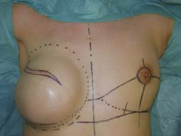 手術手技の実際 乳房形態作成に必要なのは, カプセルの扱い方, つのテクニック c d の活用, 部位別の処理方法 ( directions concept), のつで,