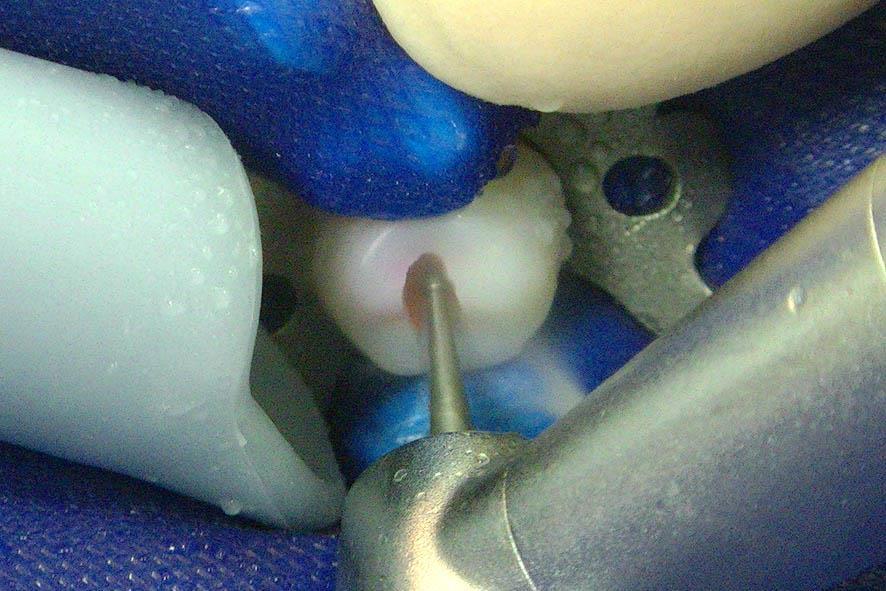 歯質が染色されなくなるまで 染色と除去を数回繰り返し行い う蝕象牙質を完全に除去する う蝕象牙質除去時にバーが到達しない場合は