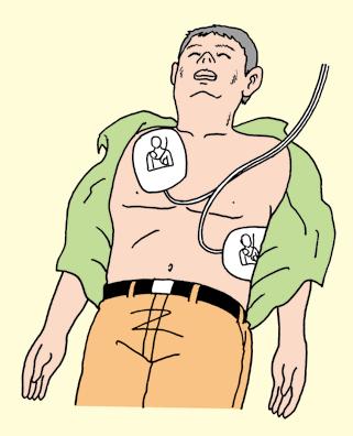 落ち着いてそれに従ってください AEDを使う準備をしながらも心肺蘇生をできるだけ続けてください 7 AED の使用 (1)AEDの準備と装着 1