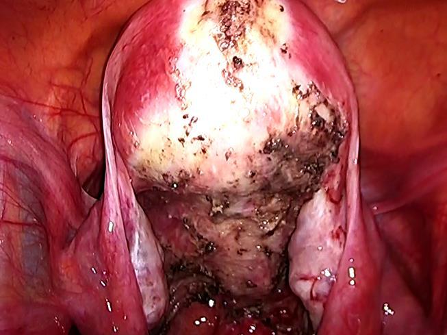 直腸腟間隙の側方のスペースから深部へ剥離を行った 直腸と子宮後頸部の癒着部を直腸プローブを操作しながら注意して剥離を進め ダグラス窩を開放した ( 図 4) ブルーベリースポットと赤色の内膜症病巣をバイポーラーにて焼灼し 腹腔内を十分洗浄した J-VAC ドレーン (15Fr) を右下腹部からダグラス窩に留置し 手術終了した 図 4.