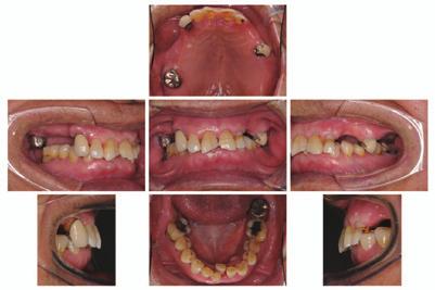 人工歯部のみで咬合挙上するのではなく, 残存歯の咬合面にアンレー型のレストを設定するなどして, 咬頭嵌合位や偏心咬合位での咬合接触が人工歯部と残存歯部との間で調和のとれている必要がある. Ⅲ. 欠損補綴治療における咬合高径 1. 残存歯と咬合高径部分欠損歯列においては, 残存歯の咬合接触状態によって最終補綴装置装着時の咬合高径の考え方は大きく異なる.
